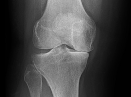 Knee Arthritis Melbourne